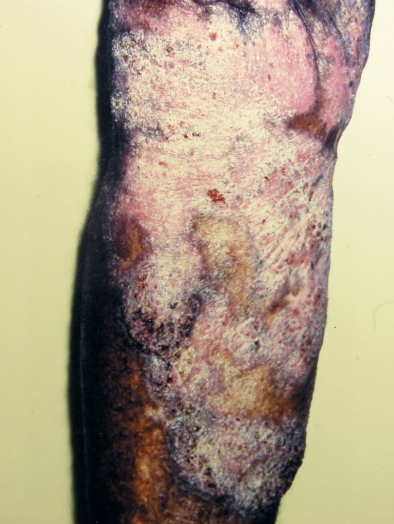 Chromoblastomycosis