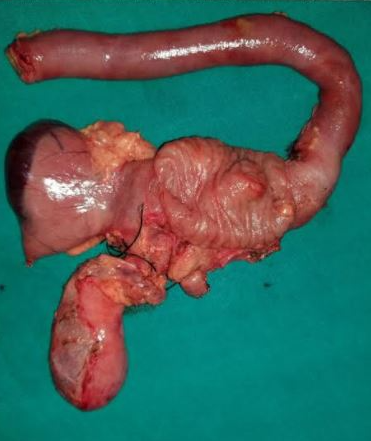 <p>Pancreaticoduodenectomy (Whipple Procedure)