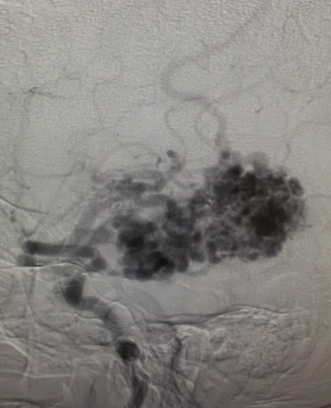 Angiogram showing the nidus of the AVM