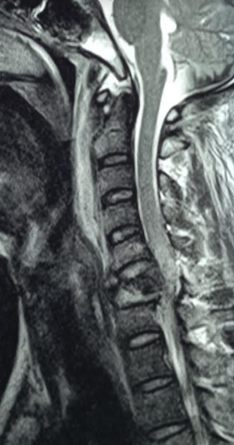 Cord compression following cervical spine injury