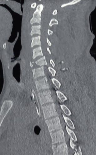 Fracture dislocation of cervical spine