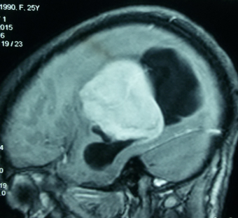 Intraventricular meningioma in contrast MRI brain