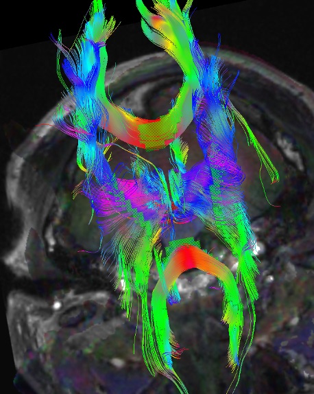 Brain tractography