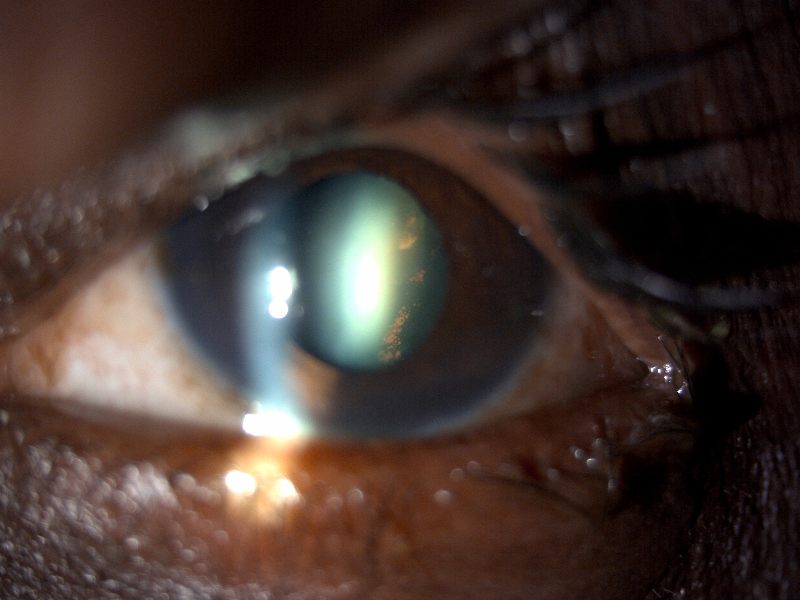 Digital slit lamp image of the patient with pigment dispersion syndrome depicting pigmentation of the anterior lens capsule
