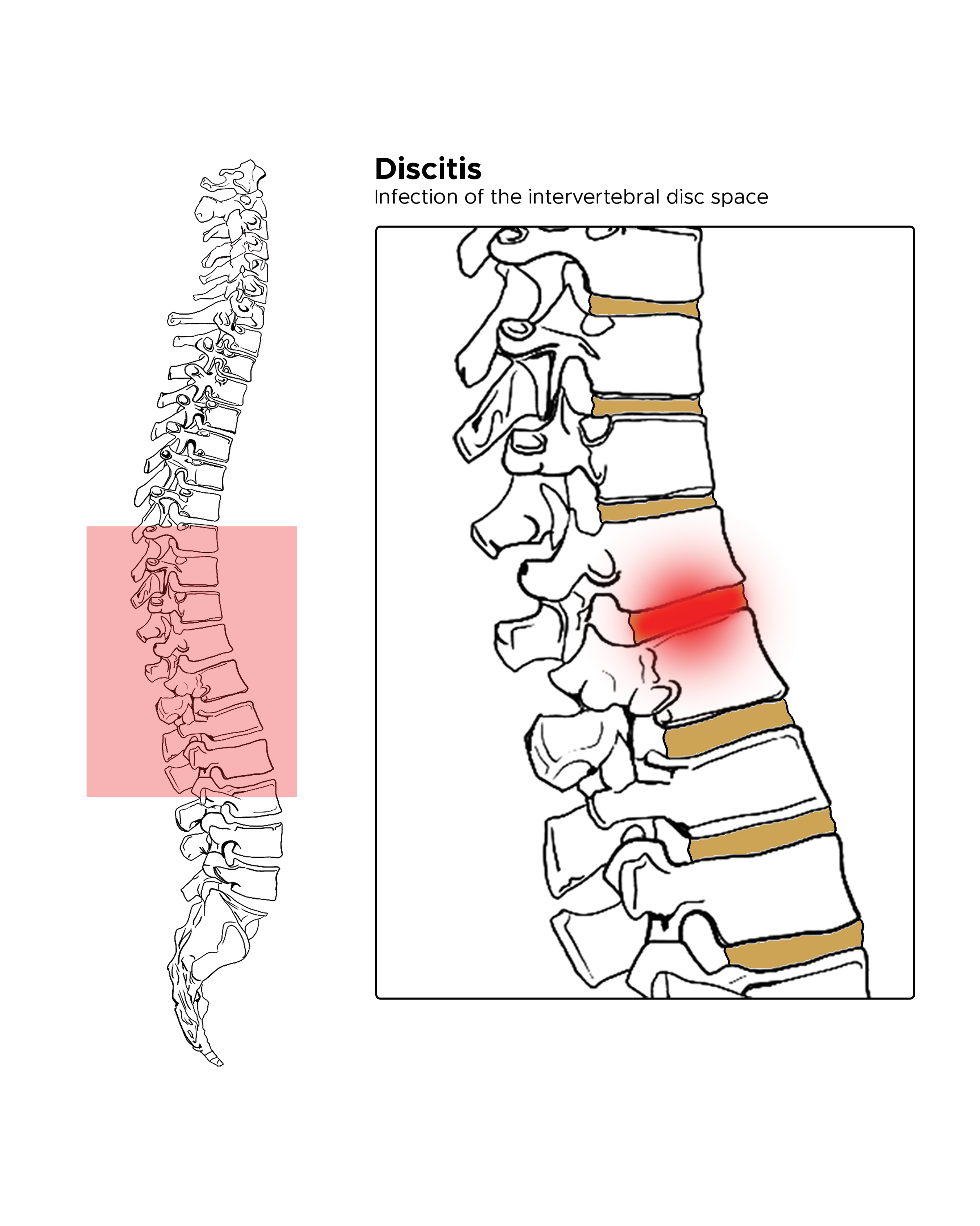 Illustration of inflamed intervertebral disc space (Discitis). Spine.