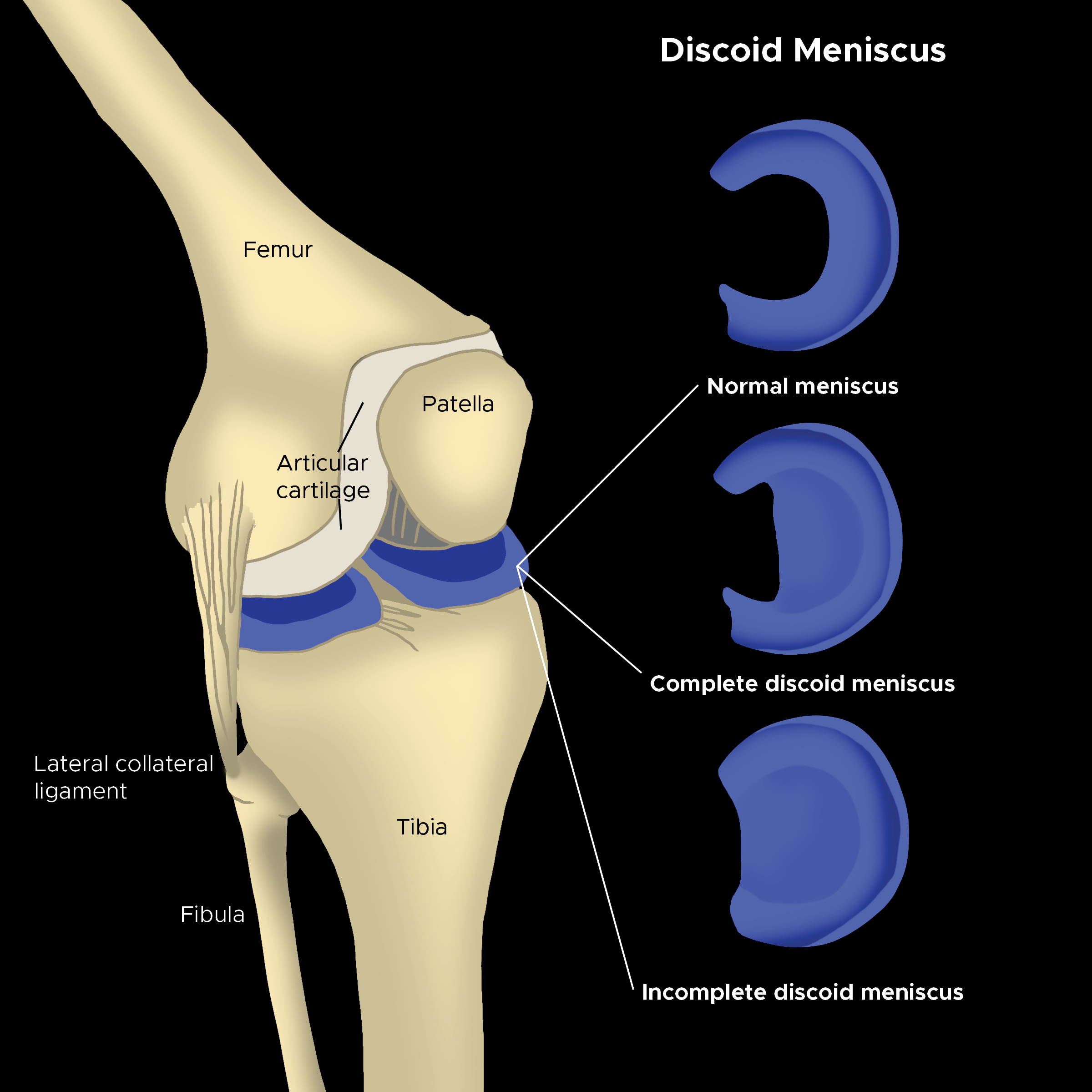 Illustration of discoid meniscus. Femur, patella, articular cartilage, tibia, lateral colateral ligament, fibula