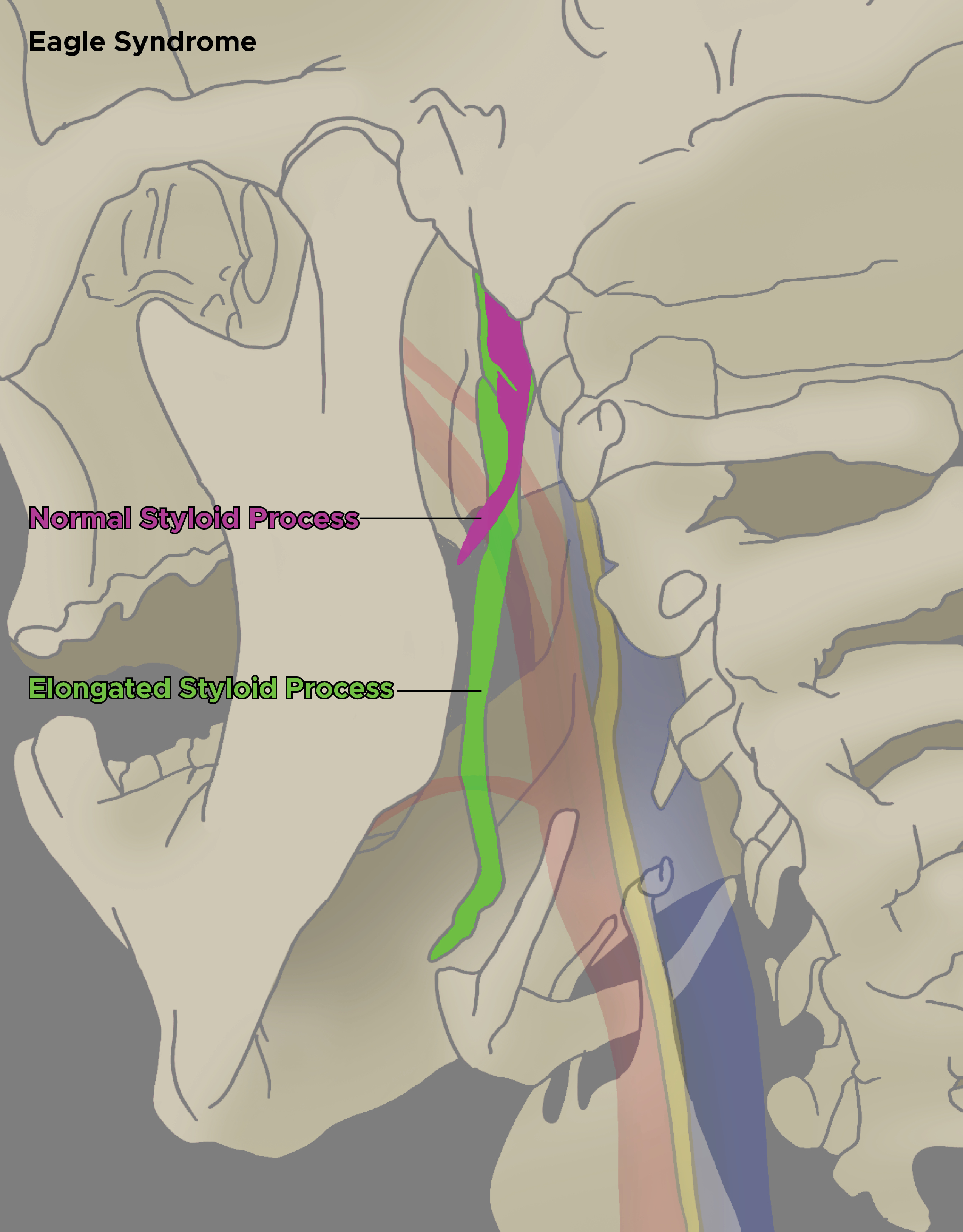 Illustration of elongated styloid process, Eagle Syndrome