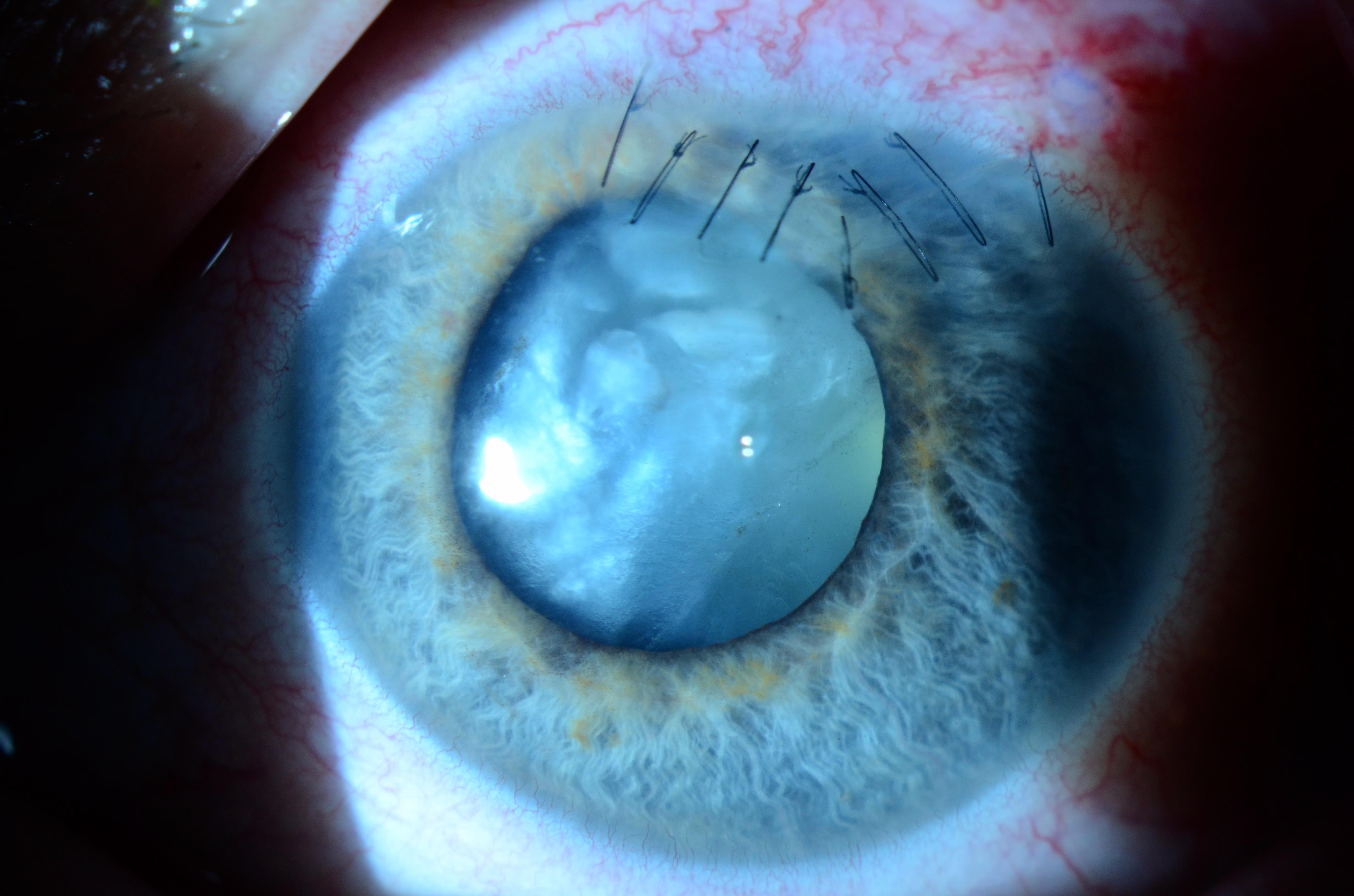 Traumatic Cataract Secondary to Penetrating Ocular Injury