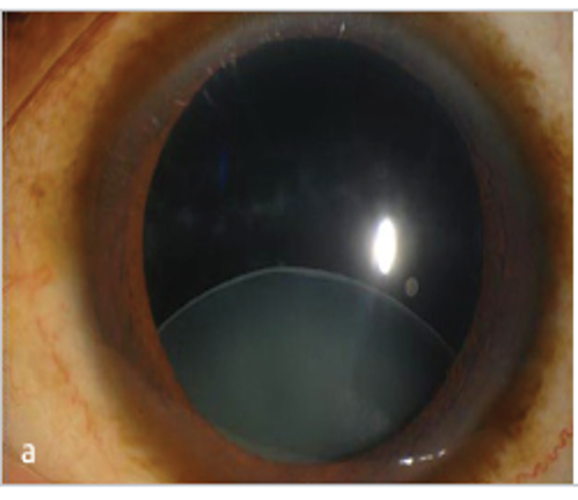 Posttraumatic Crystalline Lens Subluxation