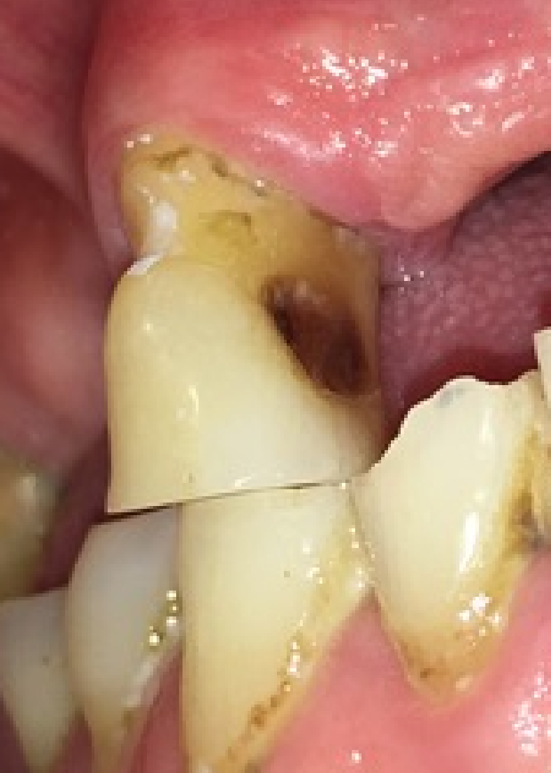 Root caries on mesial surface of 13.