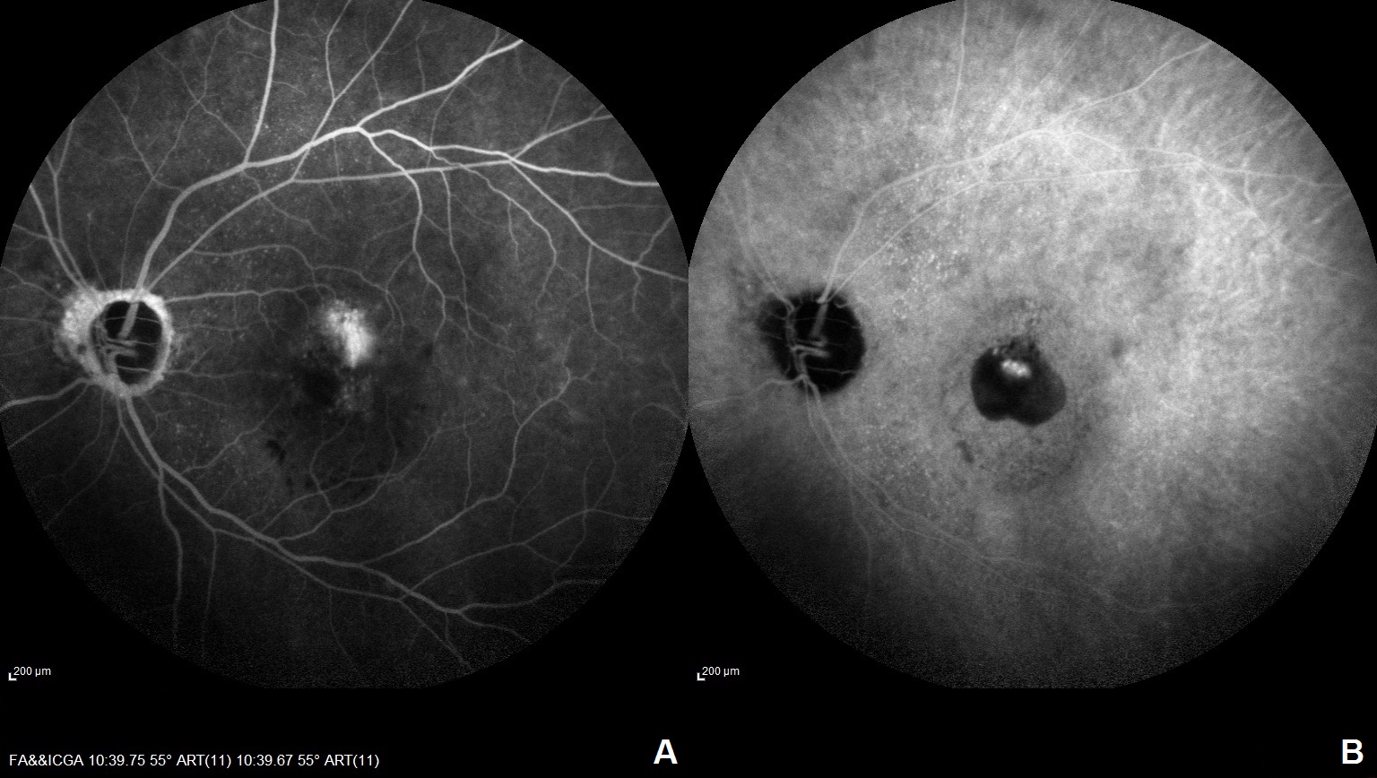 FA (A) and ICGA (B) of the left eye of a patient with PCV