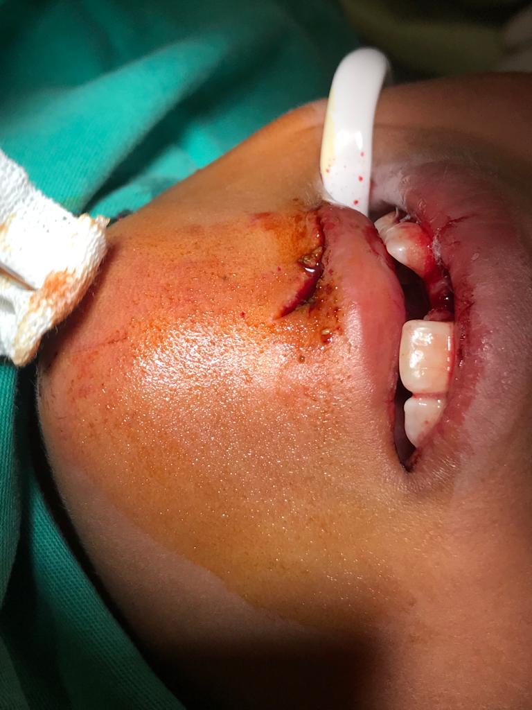Skin laceration of lower lip and chin after trauma. The 11 was avulsed.