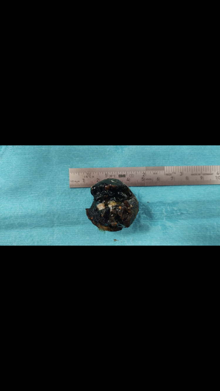 Gallstone extracted after migrating and causing gallstone ileus in the jejunum