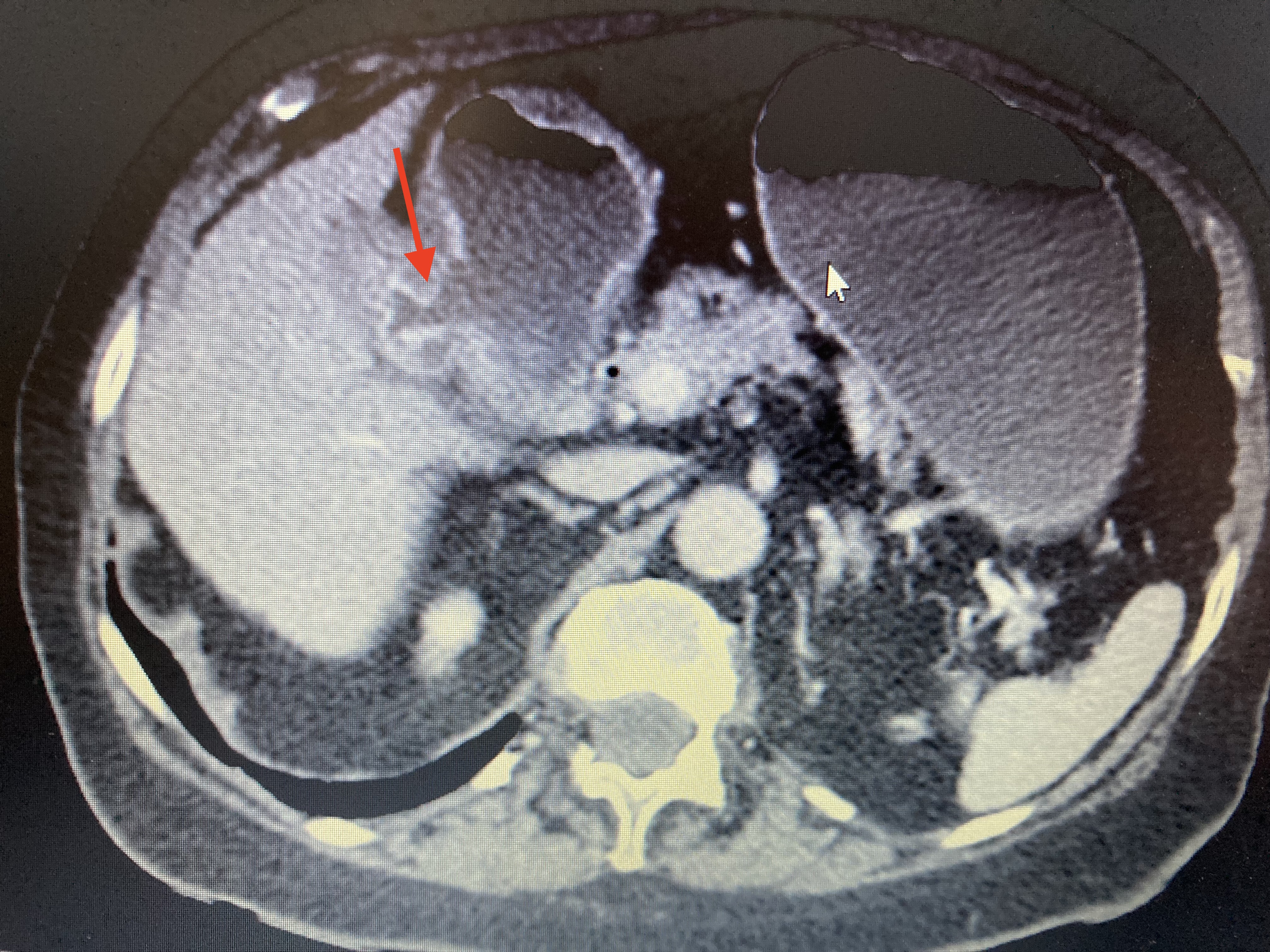 Computed tomography of the abdomen for a patient with Bouveret syndrome, showing a cholecystoduodenal fistula (shown by arrow)