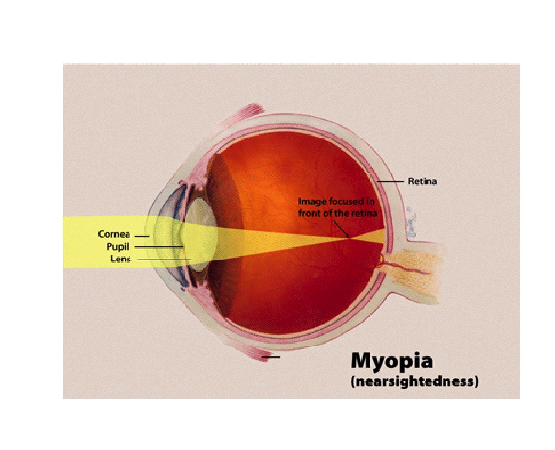 Myopia or Near Sightedness