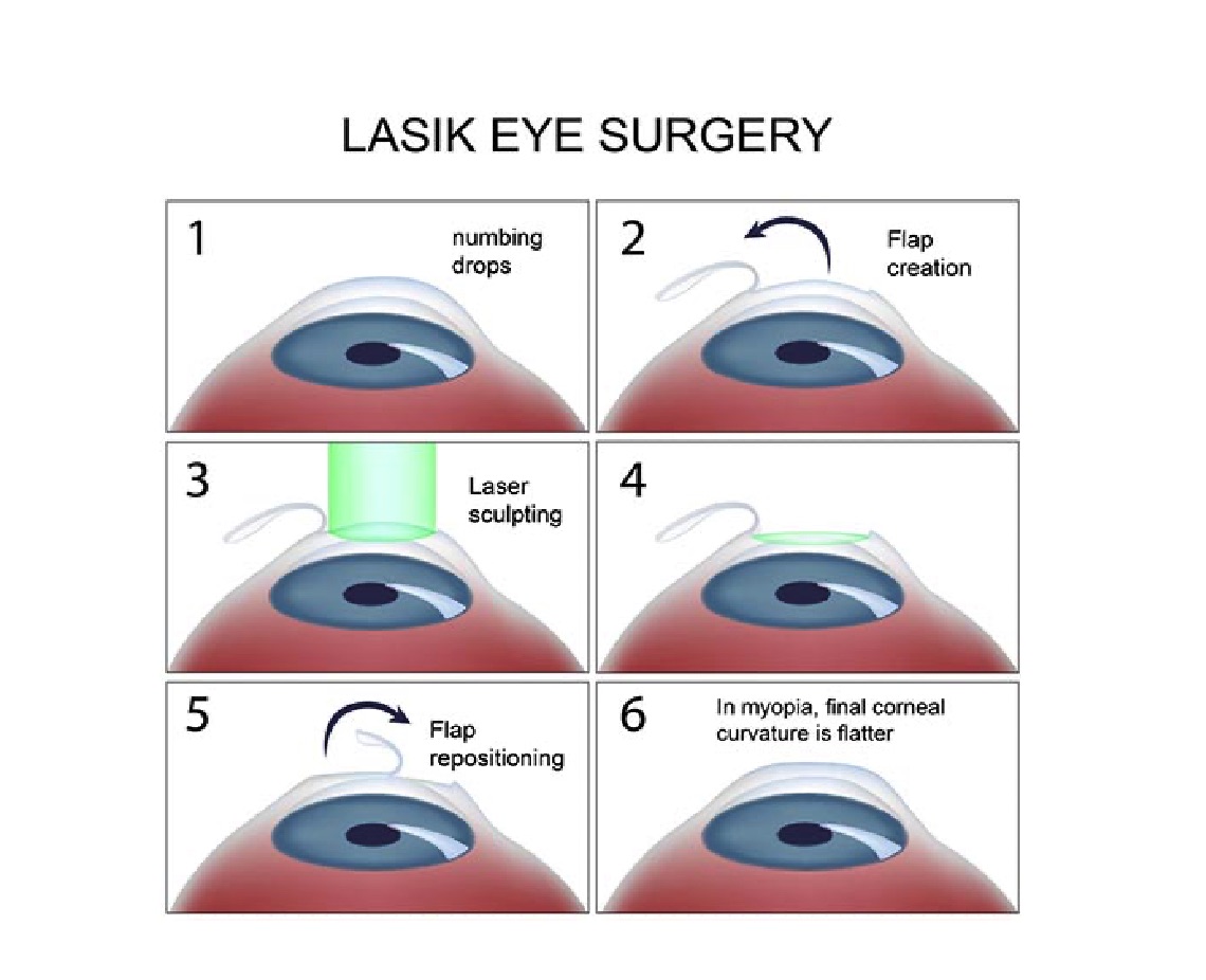 Steps Of LASIK Eye Surgery