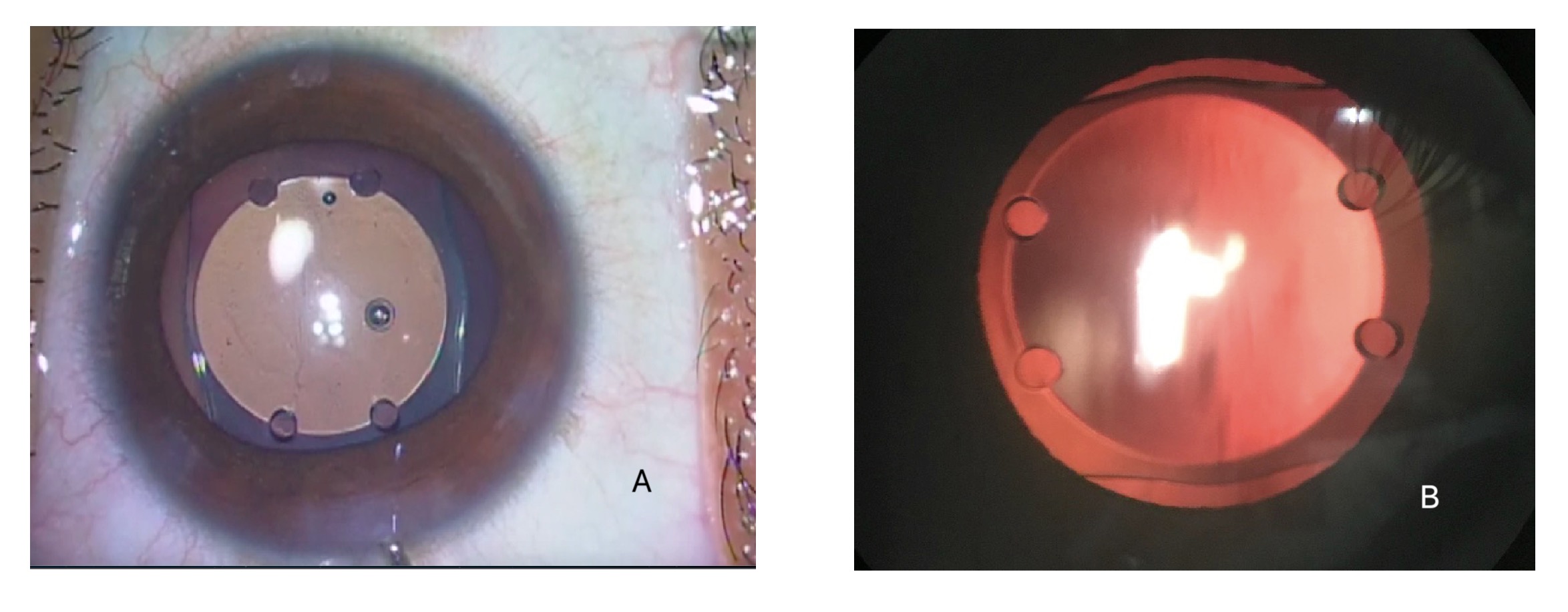 Phakic Intraocular Lens: A) Showing the intraoperative view 
                                            B) Showing the retro-illumination view with slit-lamp