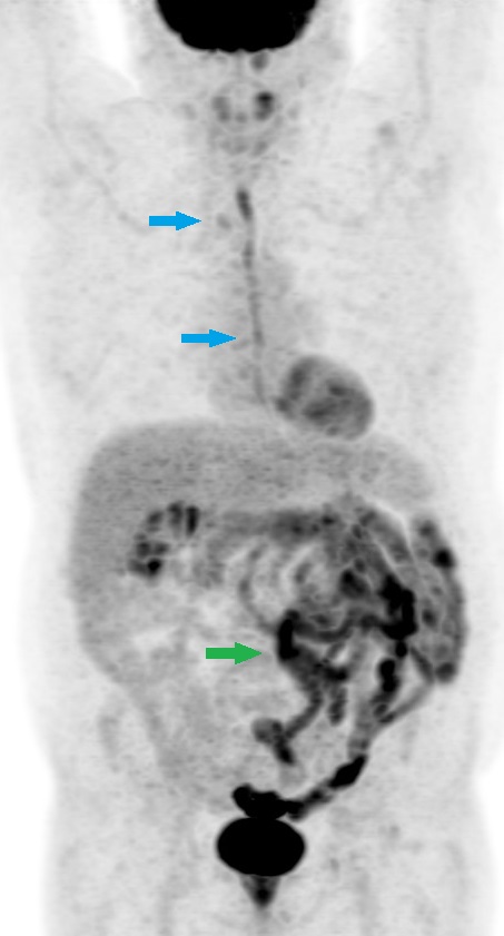 Figure 1: FDG PET/CT in a patient with dysphagia shows diffuse increased radiotracer uptake in the oesophagus consistent with oesophagitis (Blue arrows). Note heterogeneous uptake in the colon (Green arrow) due to metformin intake.