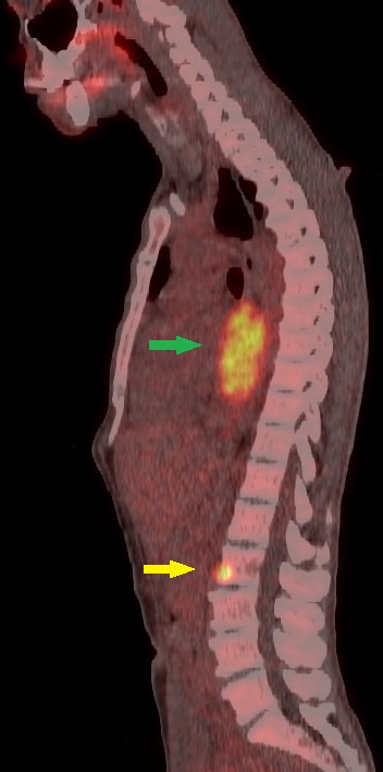 Figure 2: Sagittal fused FDG PET/CT image of a 56-year-old patient shows a highly FDG avid (SUV max 18) mass of mid-thoracic oesophagus (Green arrow) with solitary metastasis in L2 vertebral body (Yellow arrow). FDG PET/CT upstaged the disease in this patient by detecting a metastasis occult on the staging CT scan.
