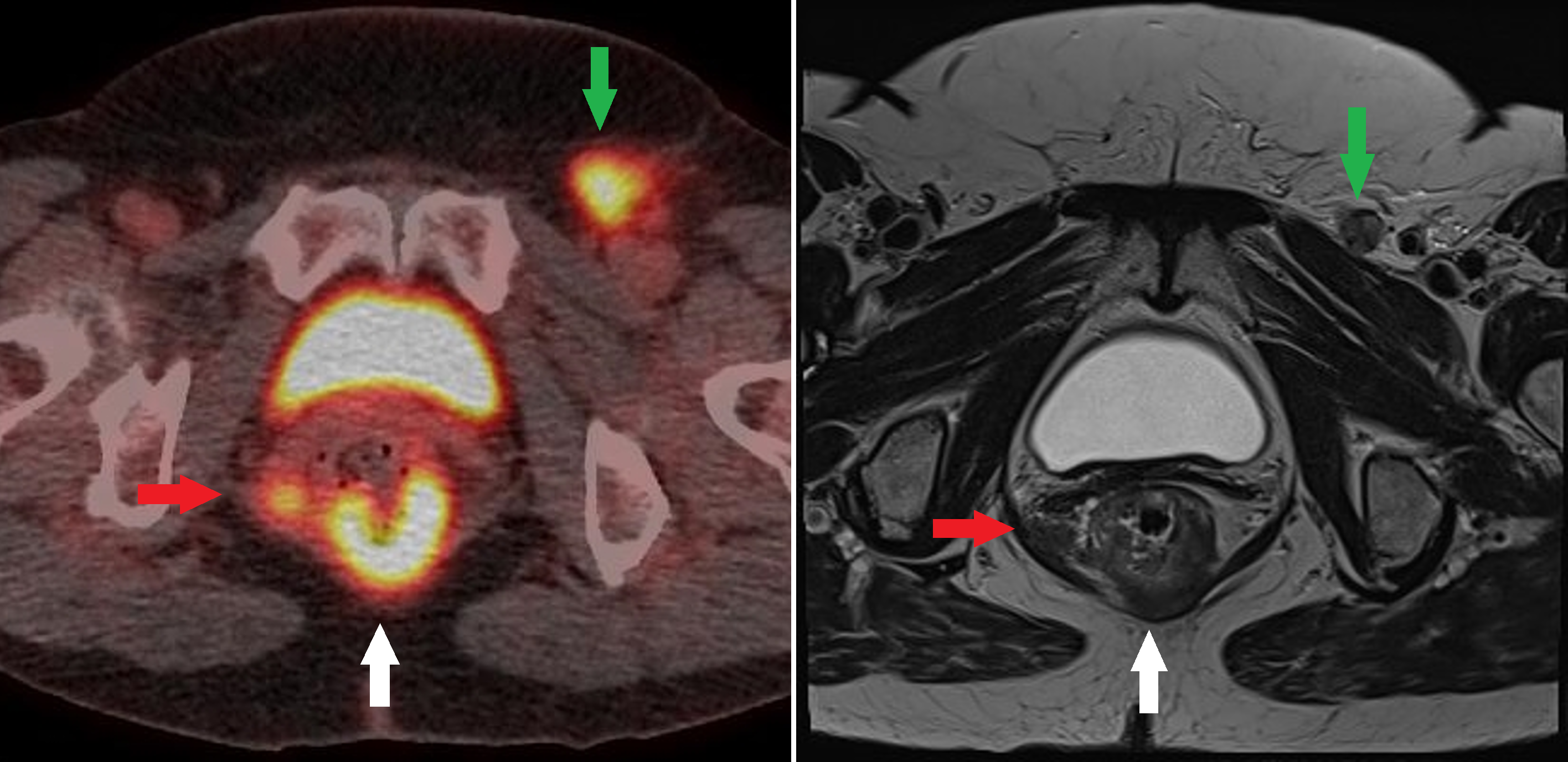 Figure 3:  Fused FDG PET/CT and T2 axial MRI images at the same level of an anorectal junction tumor (White arrow) with an FDG avid nodal deposit in the right mesorectum (Red arrow) and in the left groin (Green arrow).