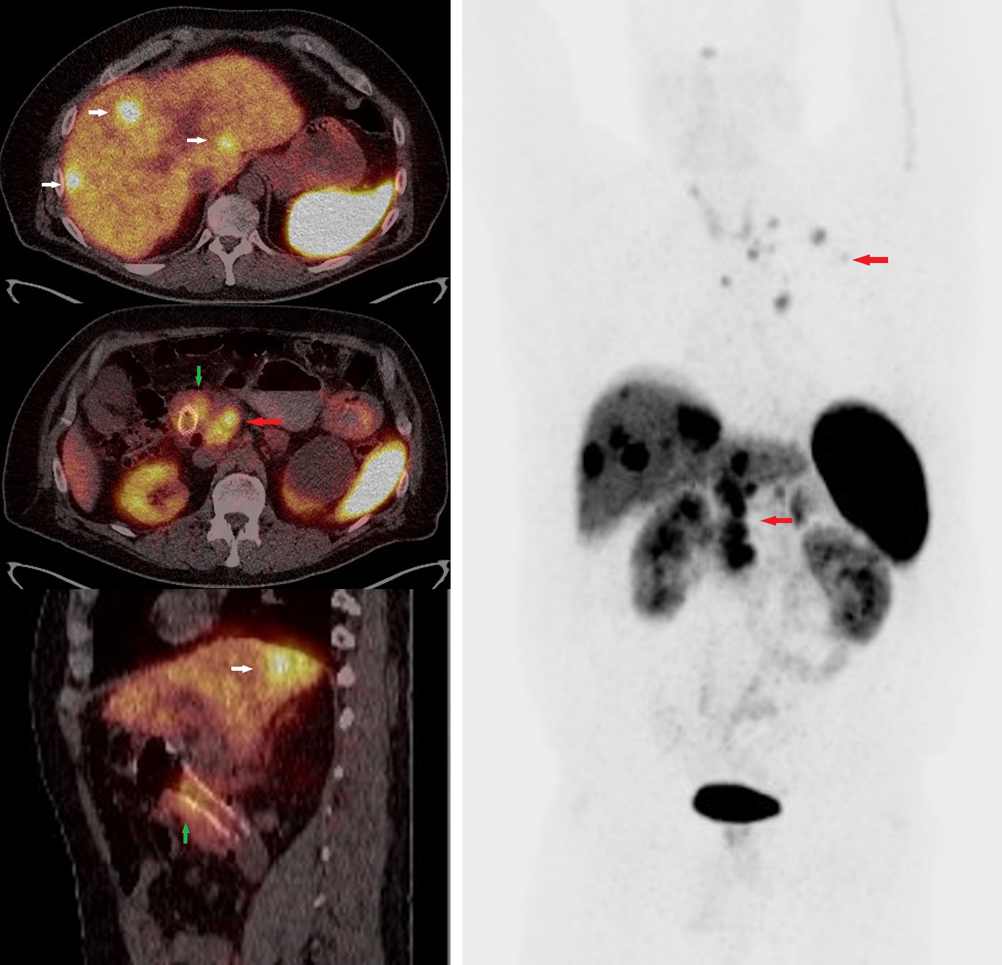 Figure 4: Ga68 DOTATOC PET/CT whole-body scan fused and MIP images of a patient with well-differentiated grade 2 neuroendocrine tumor of the duodenum with metastatic disease to the liver and lymph nodes. Green arrow: Inflammatory uptake around the stent in the duodenal tumor. Red arrows: Radiotracer uptake in conglomerate retroperitoneal and thoracic lymph nodes. White arrow: Radiotracer avid hepatic metastases.