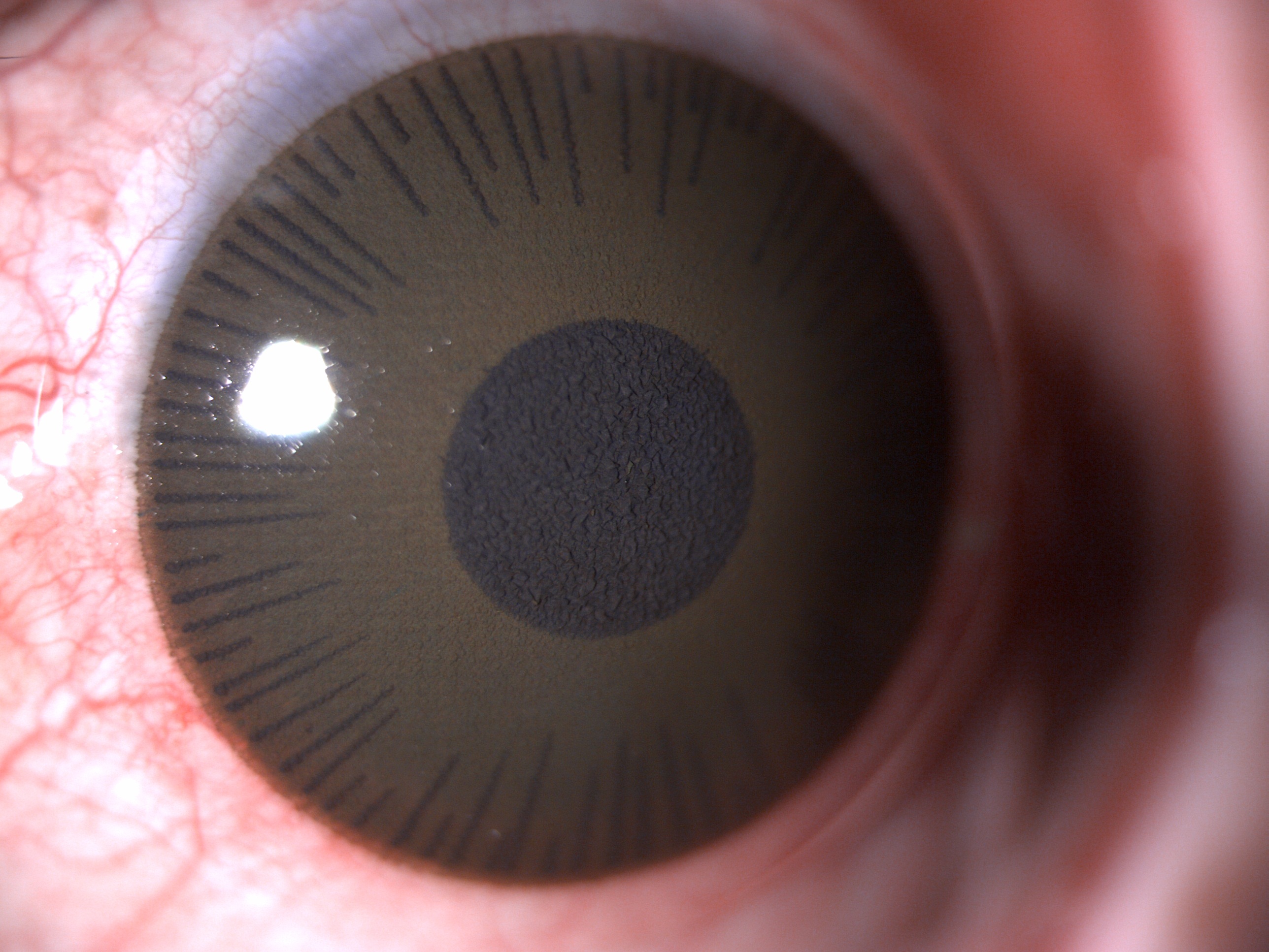 Digital image depicting a cosmetic contact lens in a patient with leucomatous corneal opacity