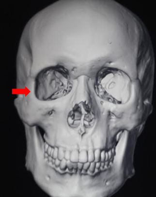 <p>Zygomatic Bone&nbsp;in 3D</p>