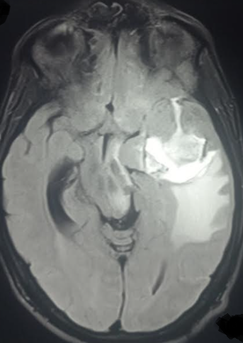 FLAIR MRI sequence in a patient presenting with partial Kluver bucy syndrome due to herpes encephalitis
