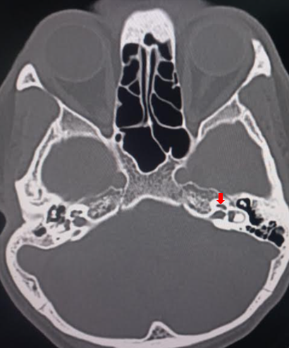 Cochlea in axial CT