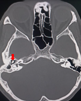 <p>Osteosclerosis on Brain Computed Tomography
