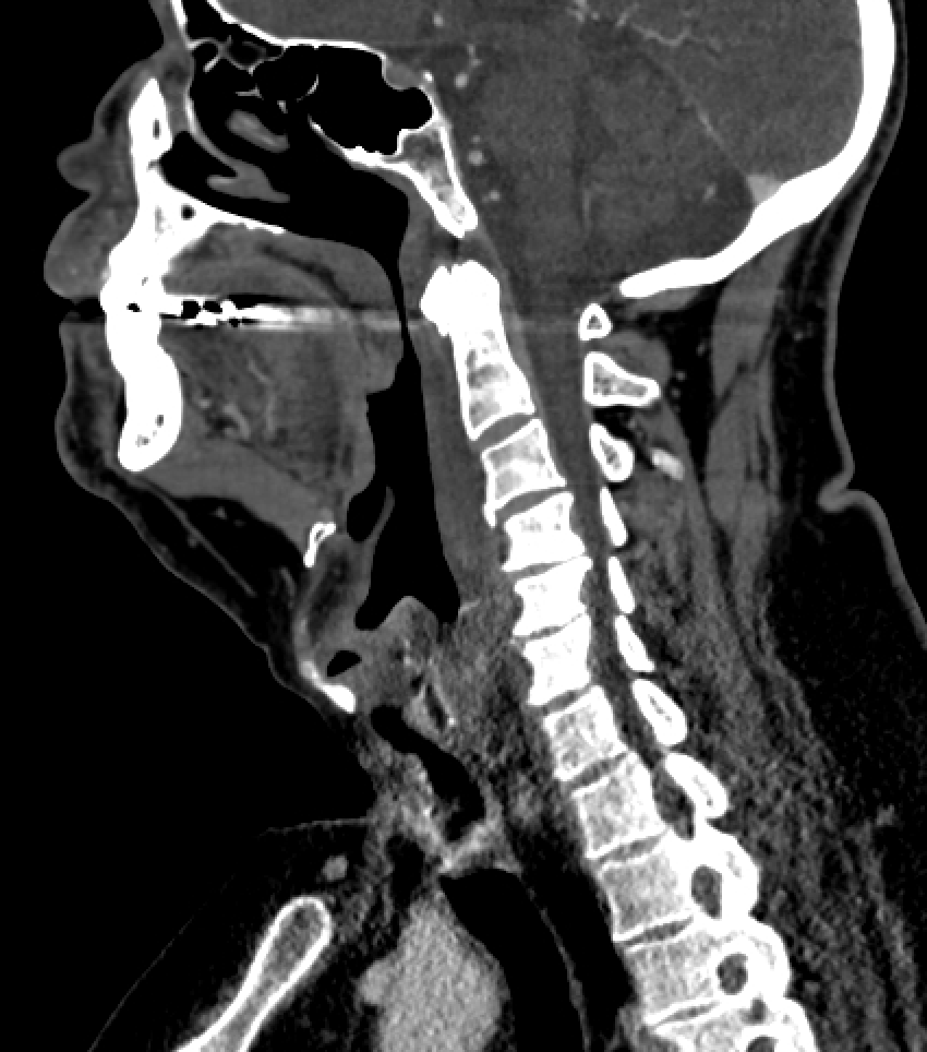 <p>Retropharyngeal Cellulitis on MRI Imaging