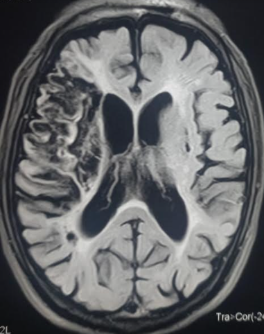 Encephalomalacia following ischemic stroke