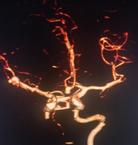 Multiple intracranial saccular aneurysms (ACOM and right MCA bifurcation)