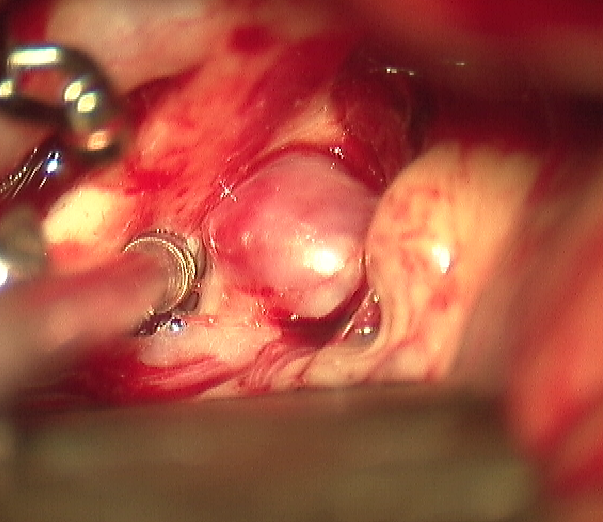 Intraoperative picture of saccular ACOM aneurysm