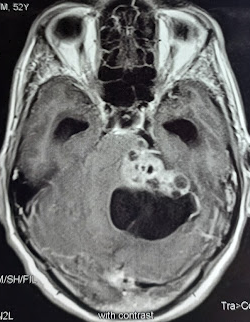 Cystic acoustic neuroma in contrast MRI