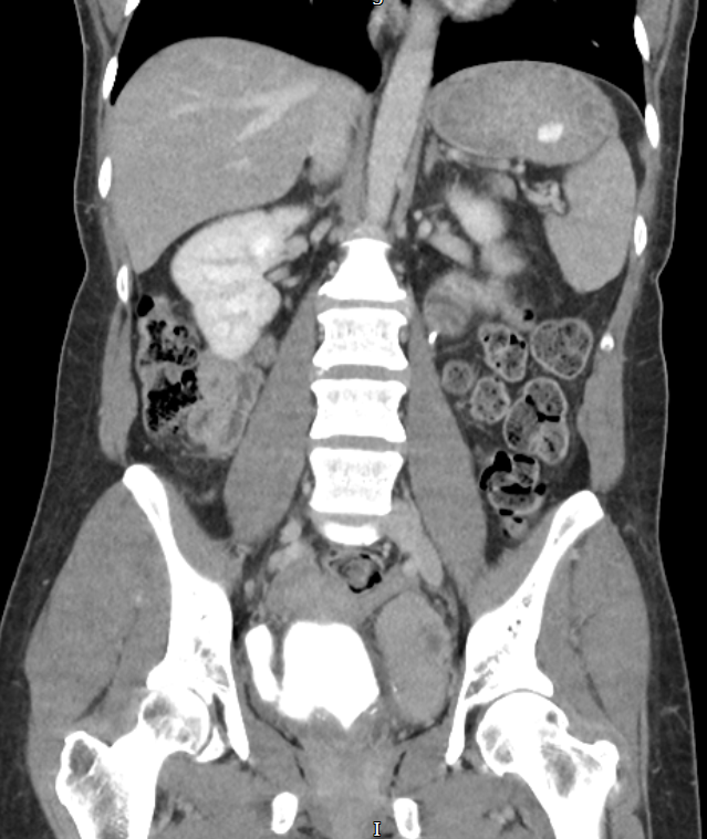 Bladder diverticulum in a patient who presented with recurrent urinary tract infection and lower abdominal tenderness.