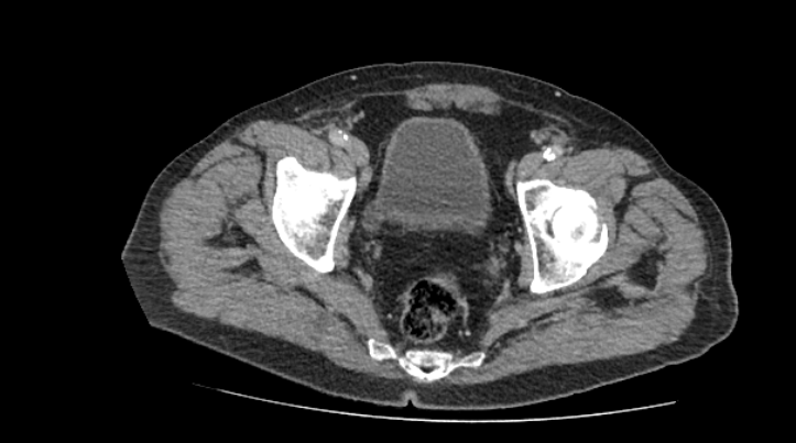 Incidental finding of a bladder diverticulum in a patient who presented with lower abdominal pain.