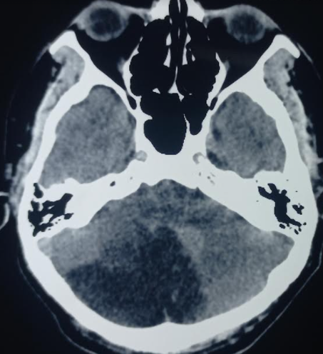 CT image of acute cerebellar infarction