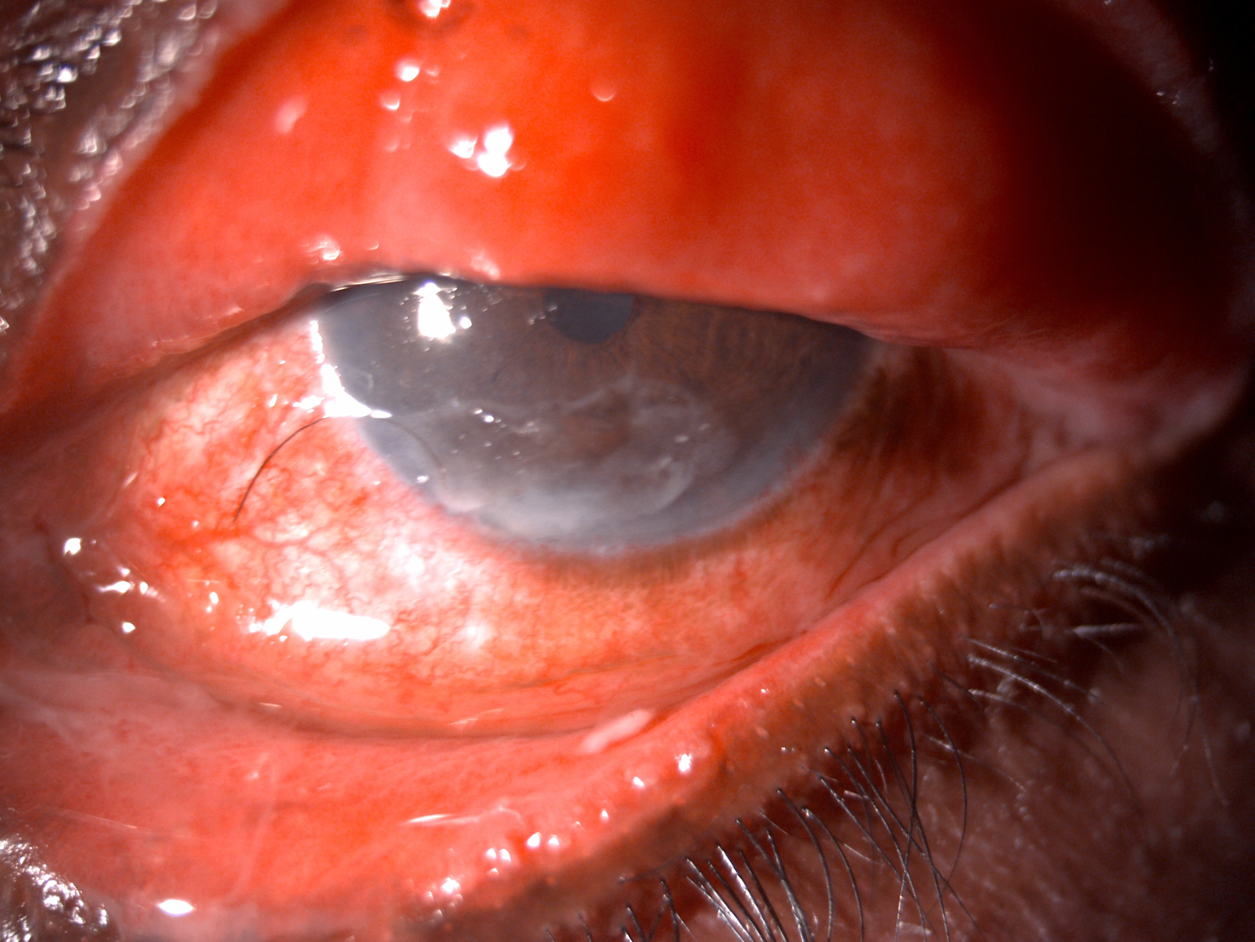 Digital slit lamp image of the patient with ocular thermal burn depicting lower lid ectropion, diffuse conjunctival congestion, conjunctival hyperemia, chemosis, mucopurulent discharge in lower tarsal conjunctival, inferior 1/3 corneal anterior stromal infiltrate suggestive of exposure keratopathy