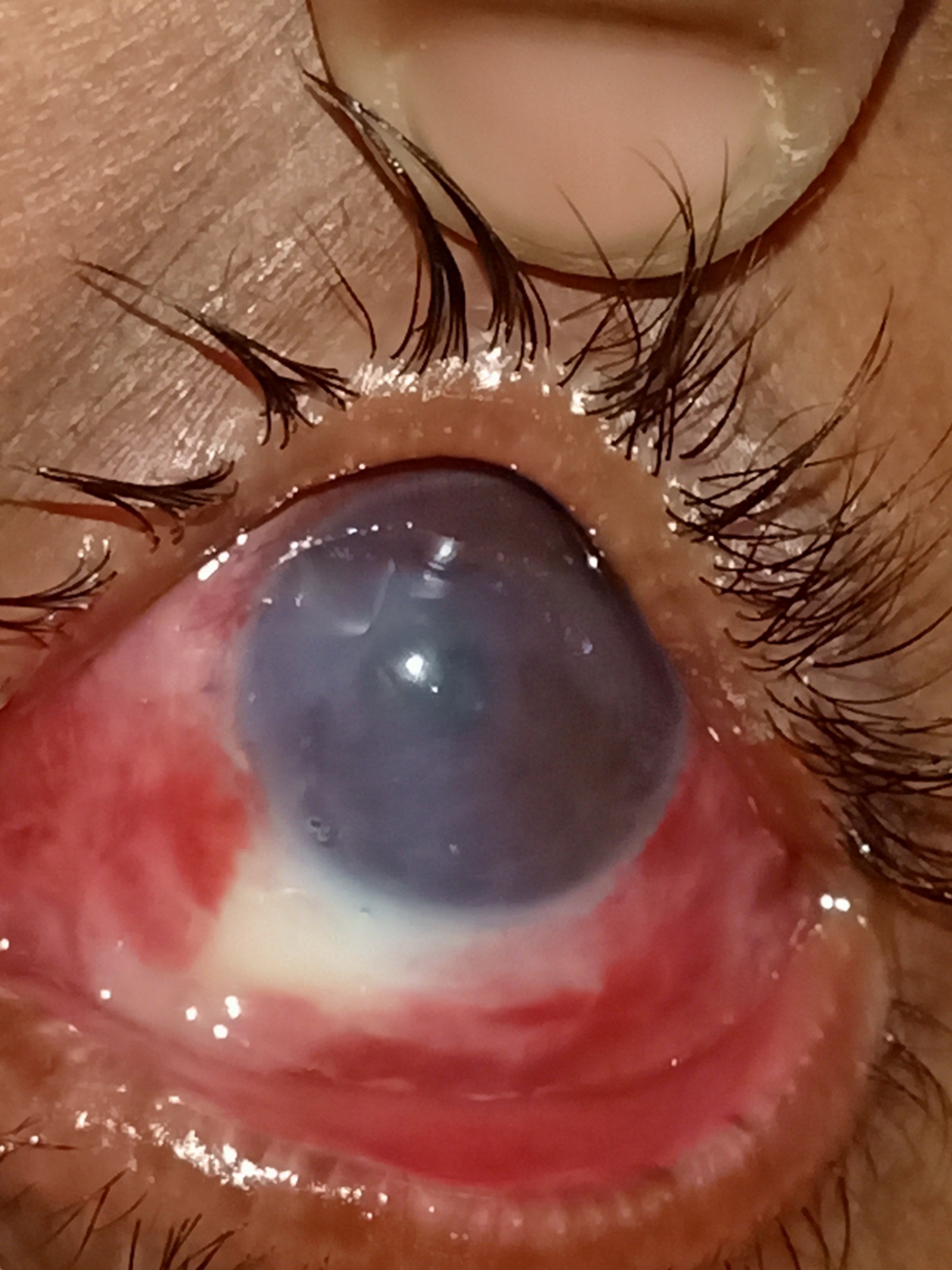 Digital slit lamp image of the patient with ocular chemical burn with lime depicting matted lashes, diffuse conjunctival congestion, blanching, stromal edema and inferior limbal stem cell deficiency