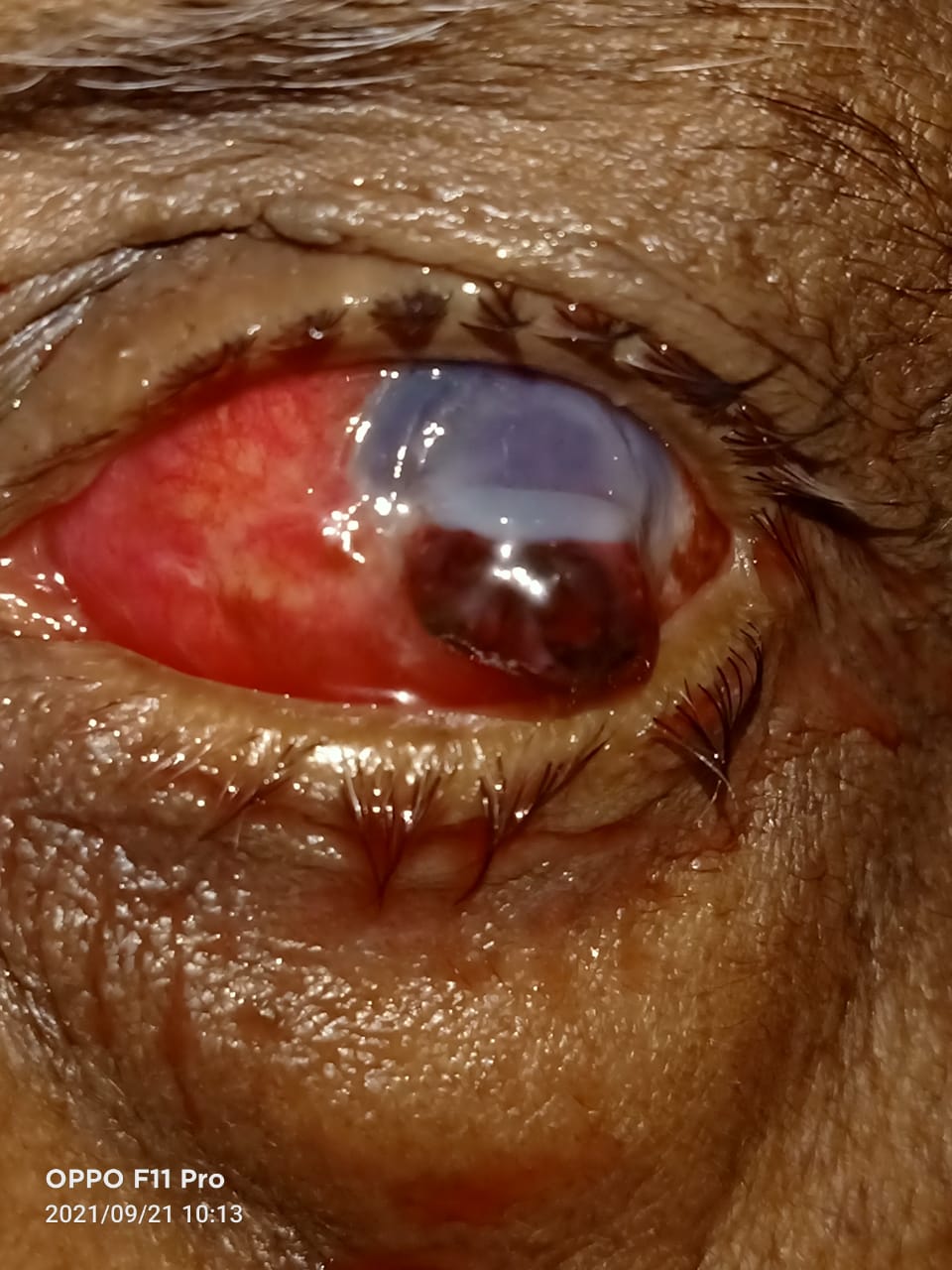 Digital image of the patient depicting inferior limbal laceration with prolapse of uveal tissue post iron nail injury