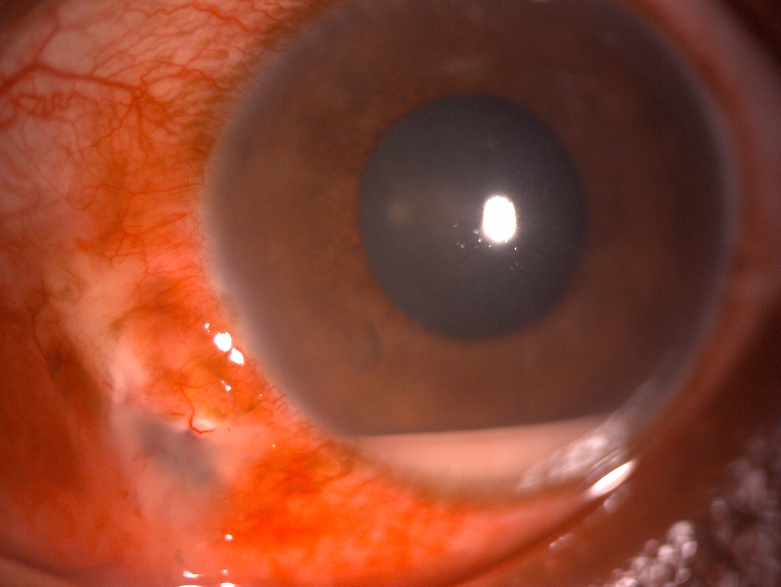 Digital slit lamp image of the patient depicting diffuse conjunctival congestion, inferotemporal scleral tear, 2 mm hypopyon and rest of the details are normal