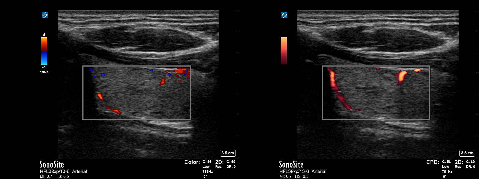 Figure 2: Example of visualization of low flow with color Doppler (left) vs. power Doppler (right) using thyroid tissue