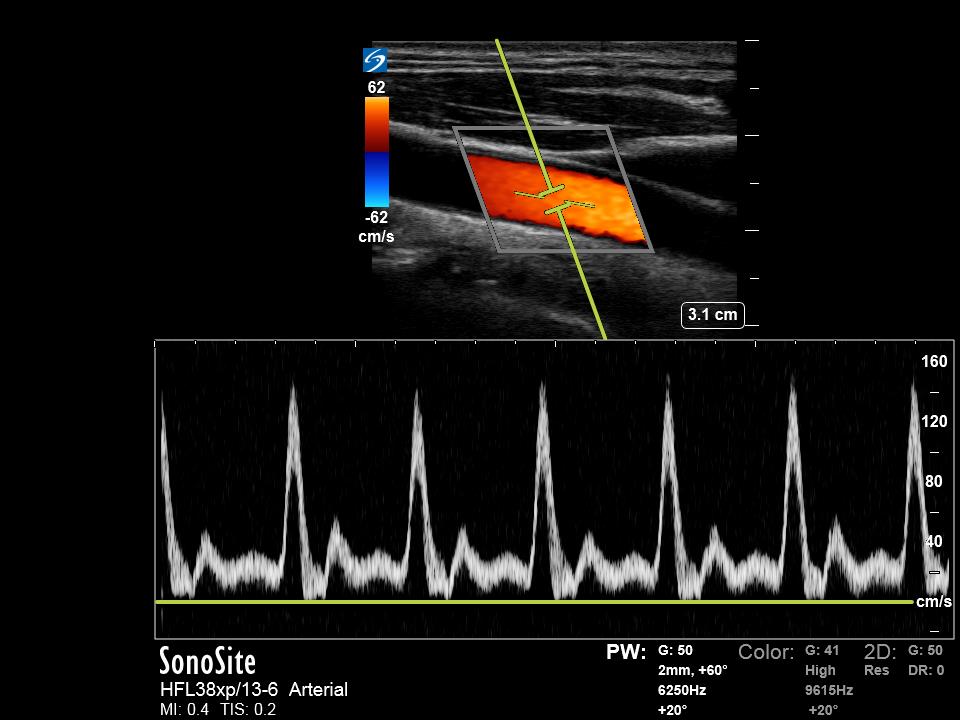 Figure 3: Example of optimized spectral PW Doppler waveform while imaging normal flow in common carotid artery