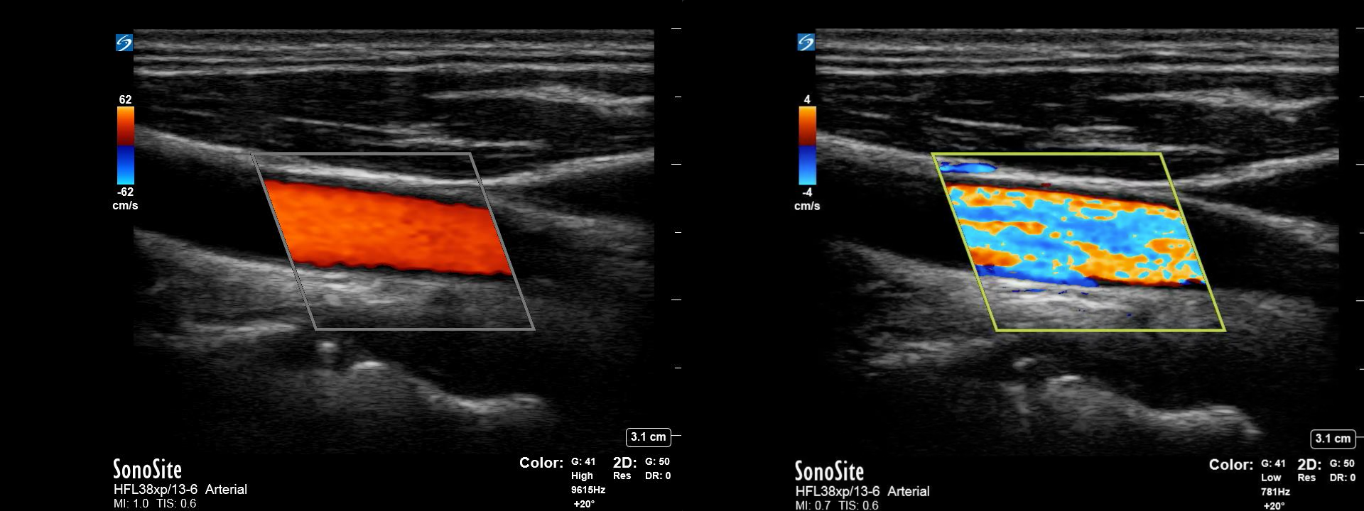 Figure 4: Example of optimized color Doppler imaging of the common carotid artery (left) vs. imaging with scale set too low (right) and associated aliasing artifact