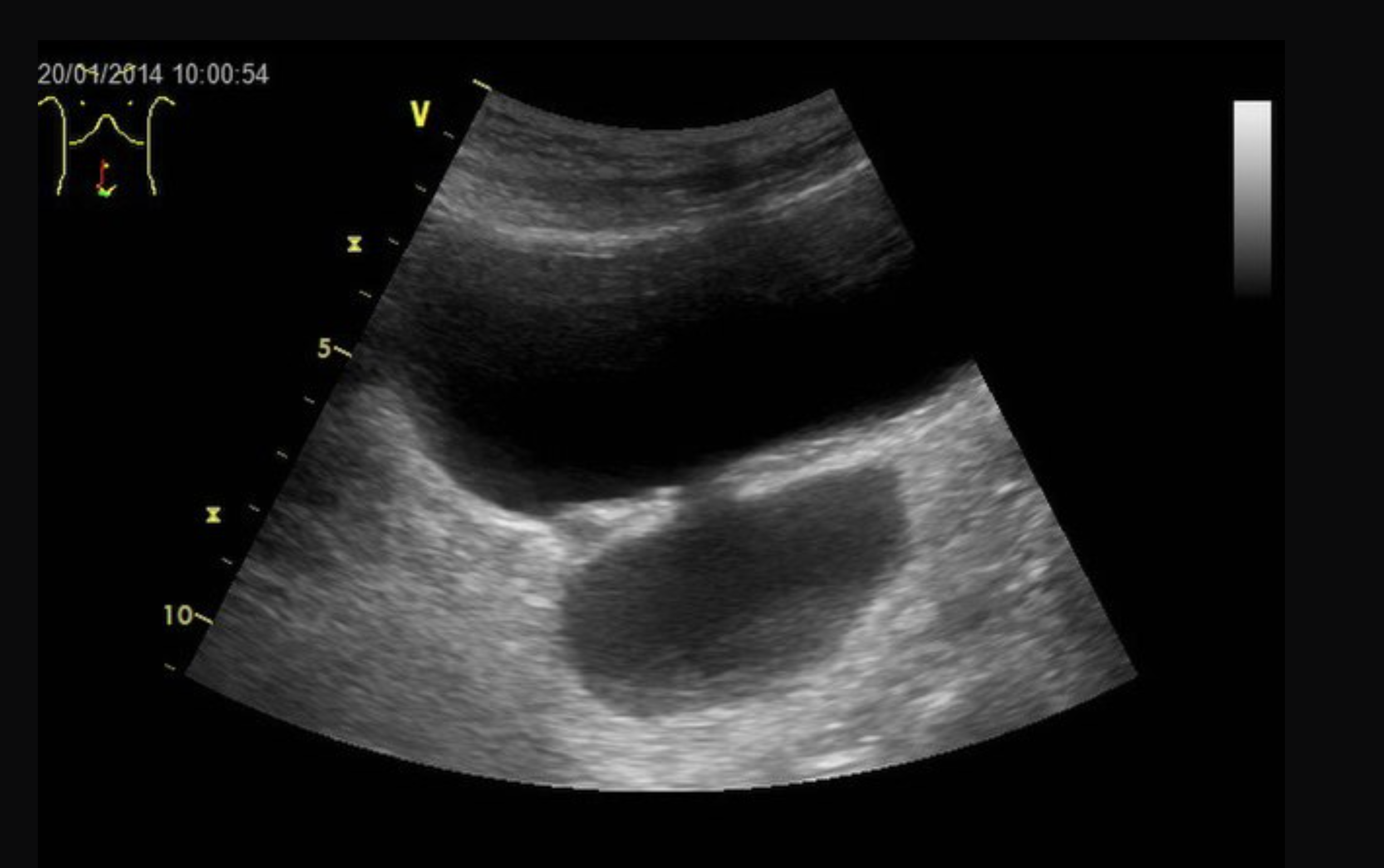 Ultrasound of a bladder diverticulum in a 59-year-old man, sagittal plane.