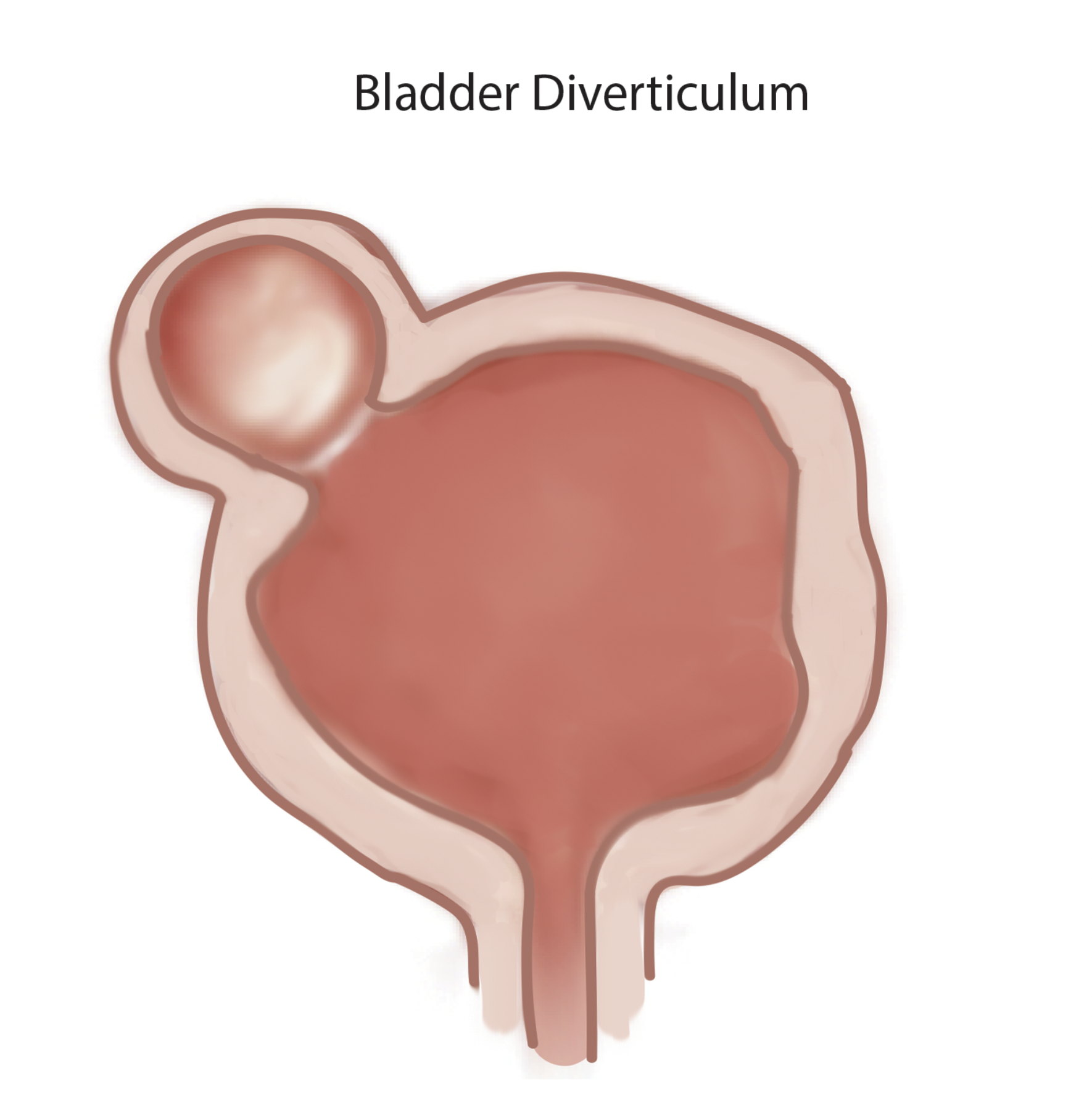Illustration of a bladder diverticulum.