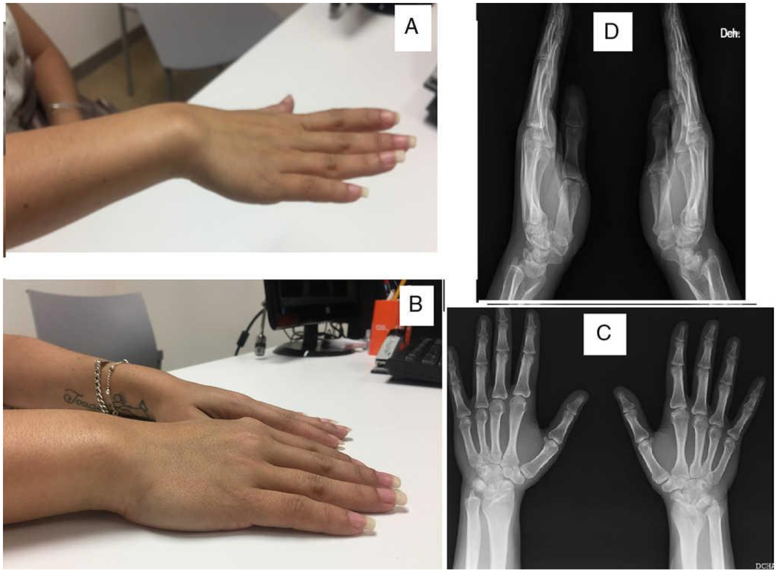 <p>Right Madelung Deformity
