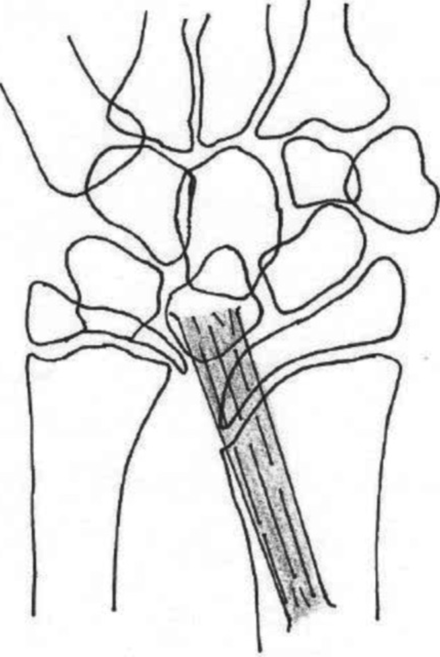 <p>Vickers Ligament