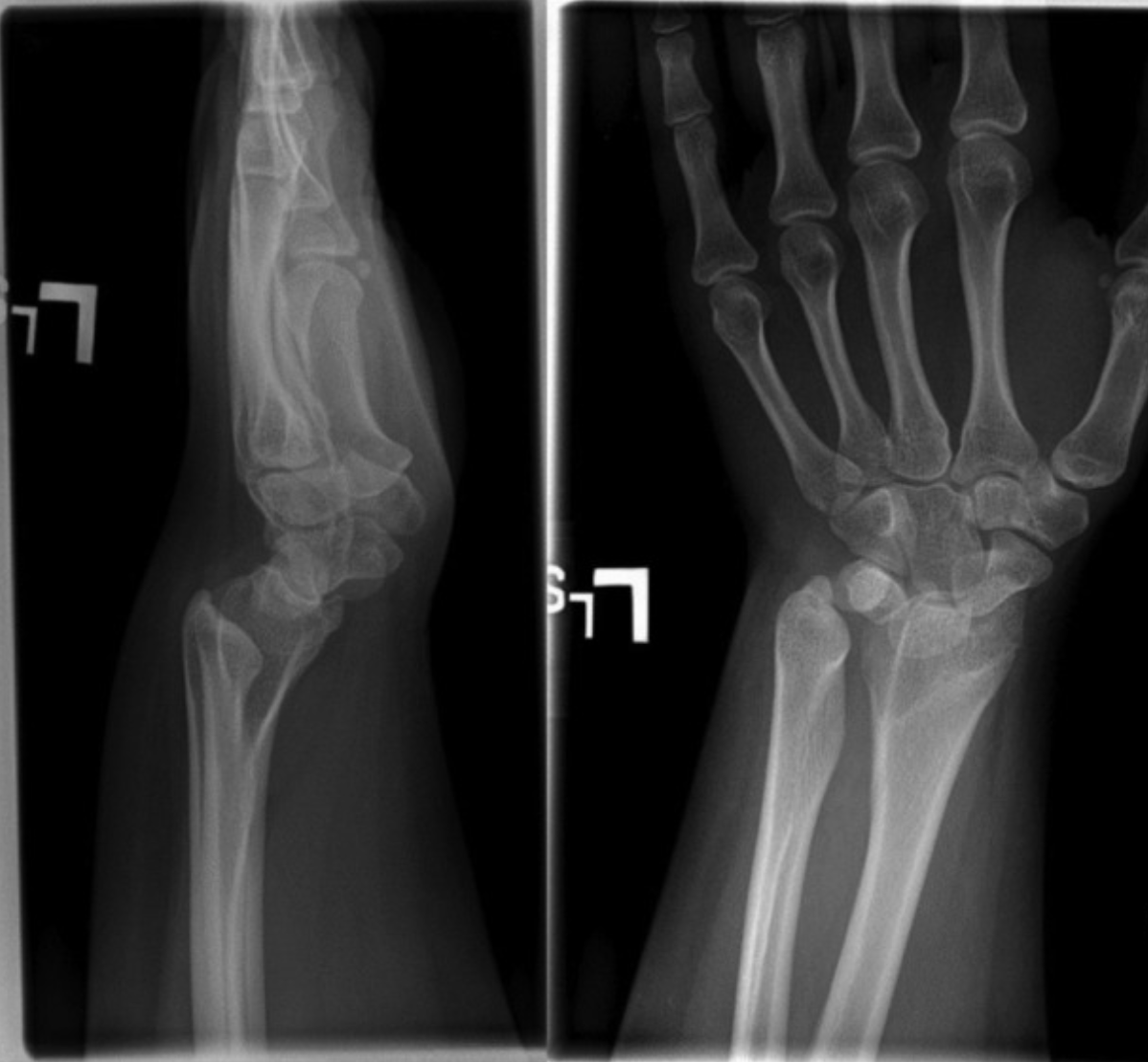 <p>Madelung Deformity Lateral and&nbsp;Anteroposterior&nbsp;Radiographs